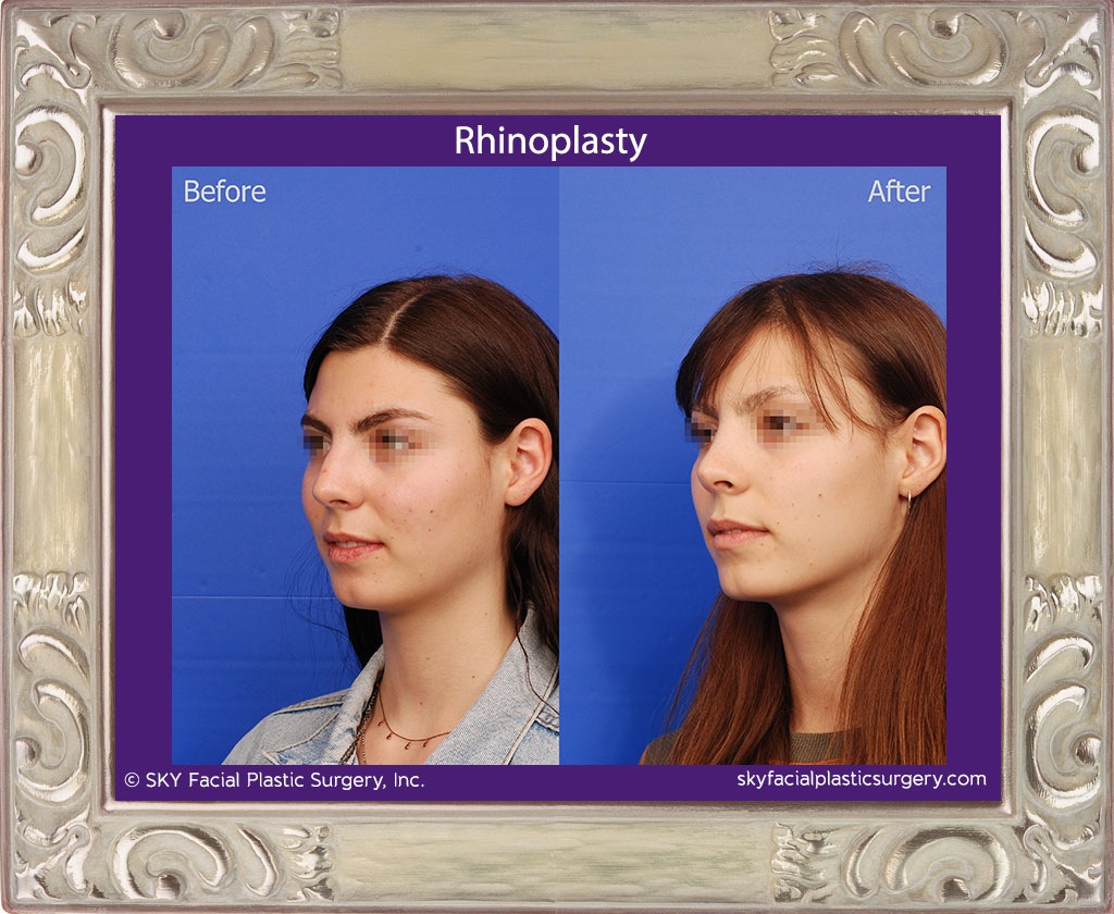 Rhinoplasty - San Diego