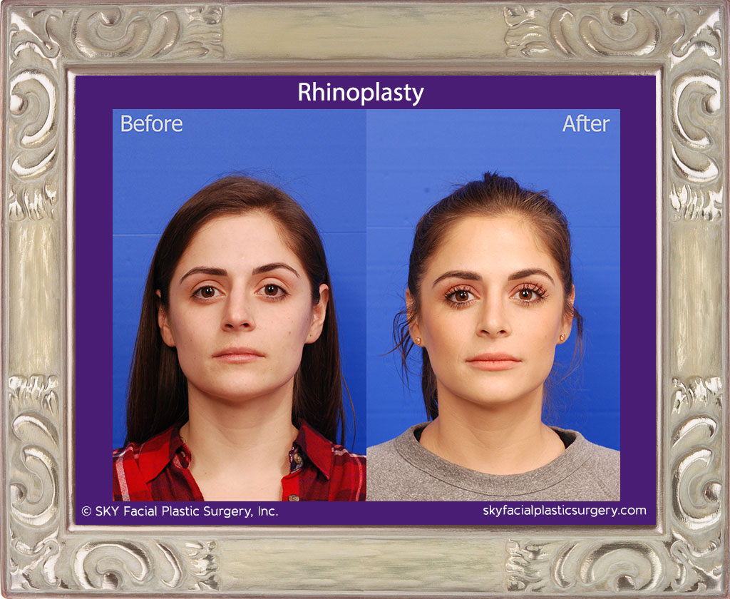 Rhinoplasty - San Diego