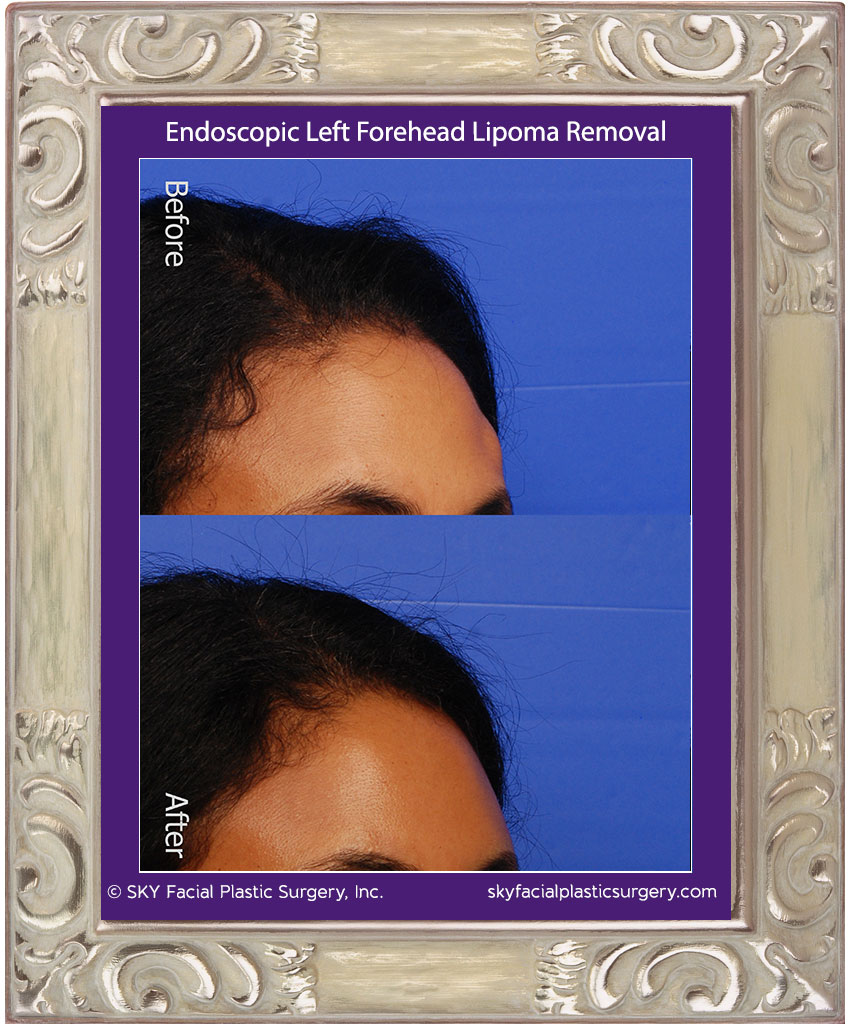 Scarless Forehead Lipoma Removal