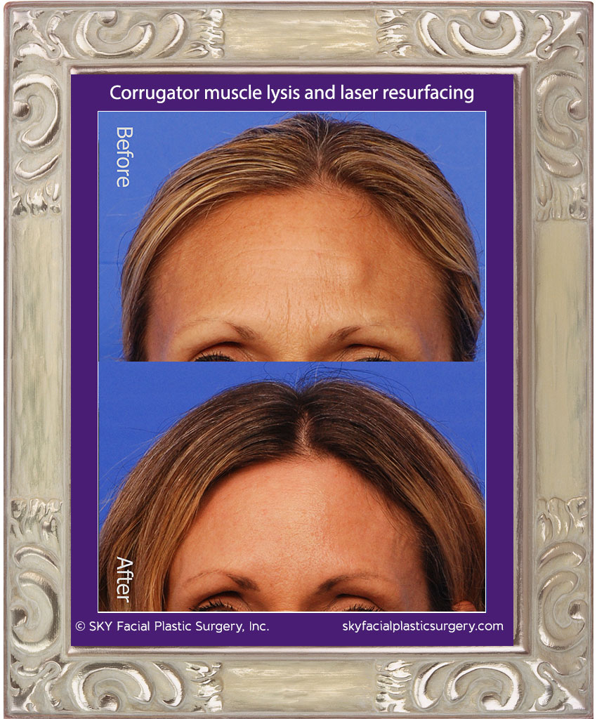 Corrugator Muscle Lysis Frown Lines Removal Sky Facial Plastic