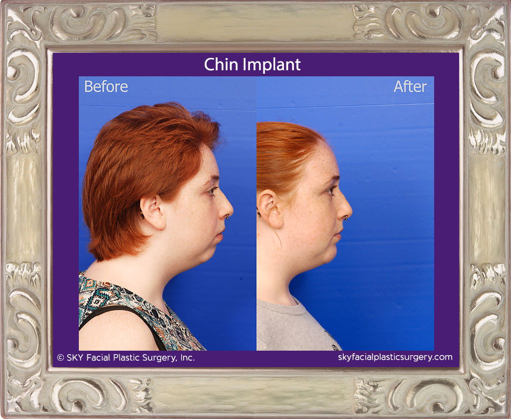 Chin Implant