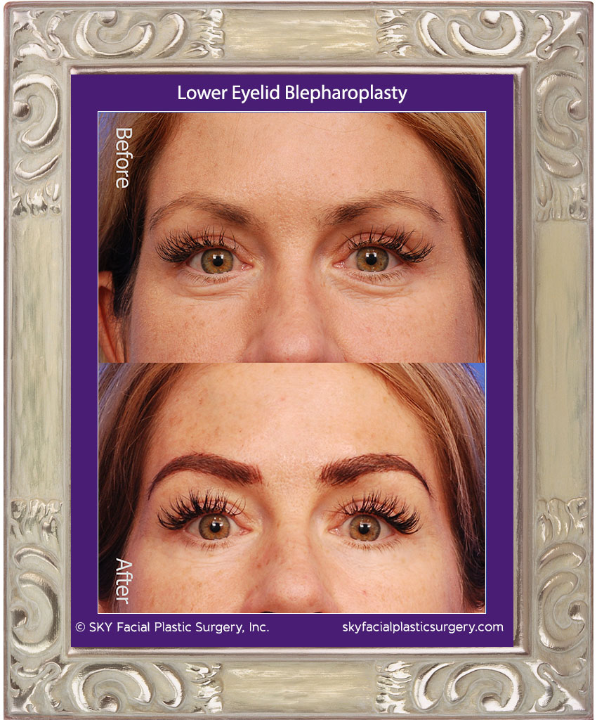 Lower Blepharoplasty - San Diego