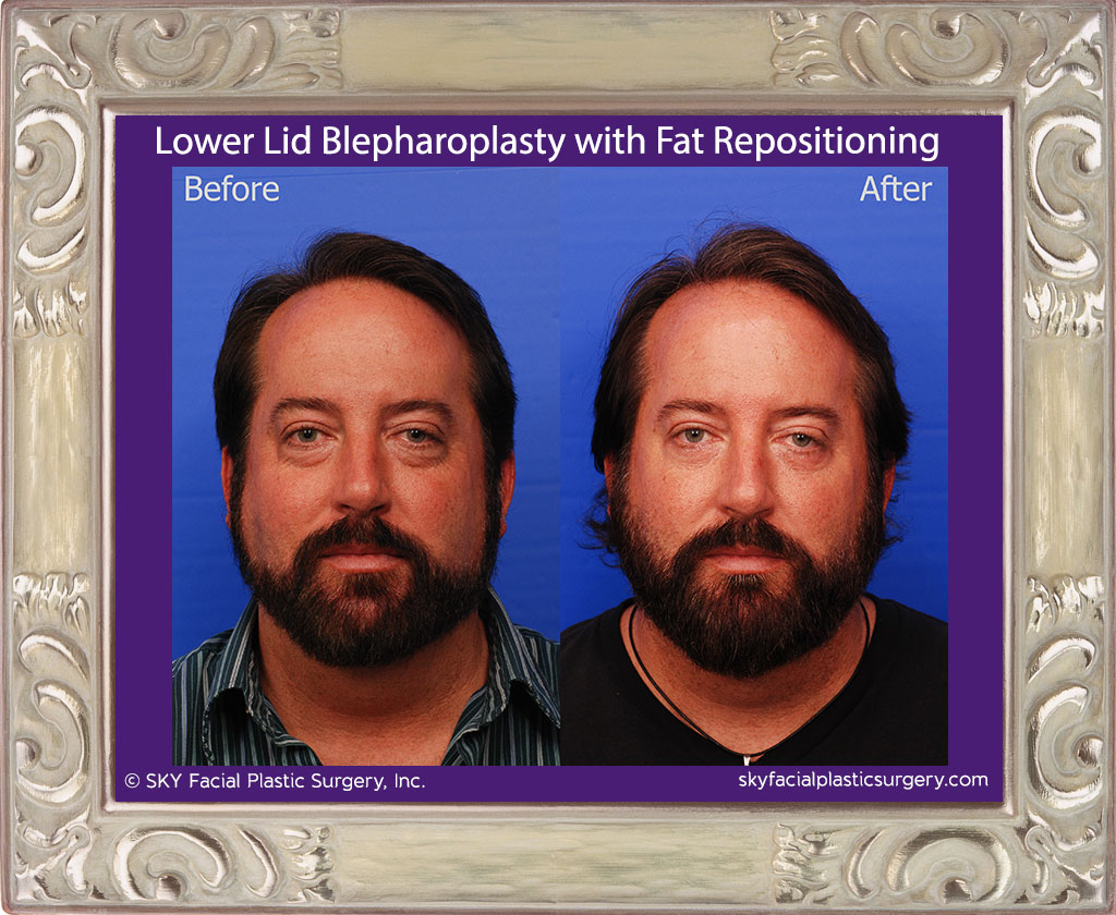 Lower Eyelid Blepharoplasty with Fat Repositioning - San Diego