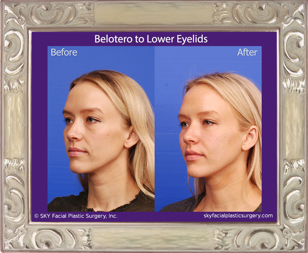 Filler to lower eyelids