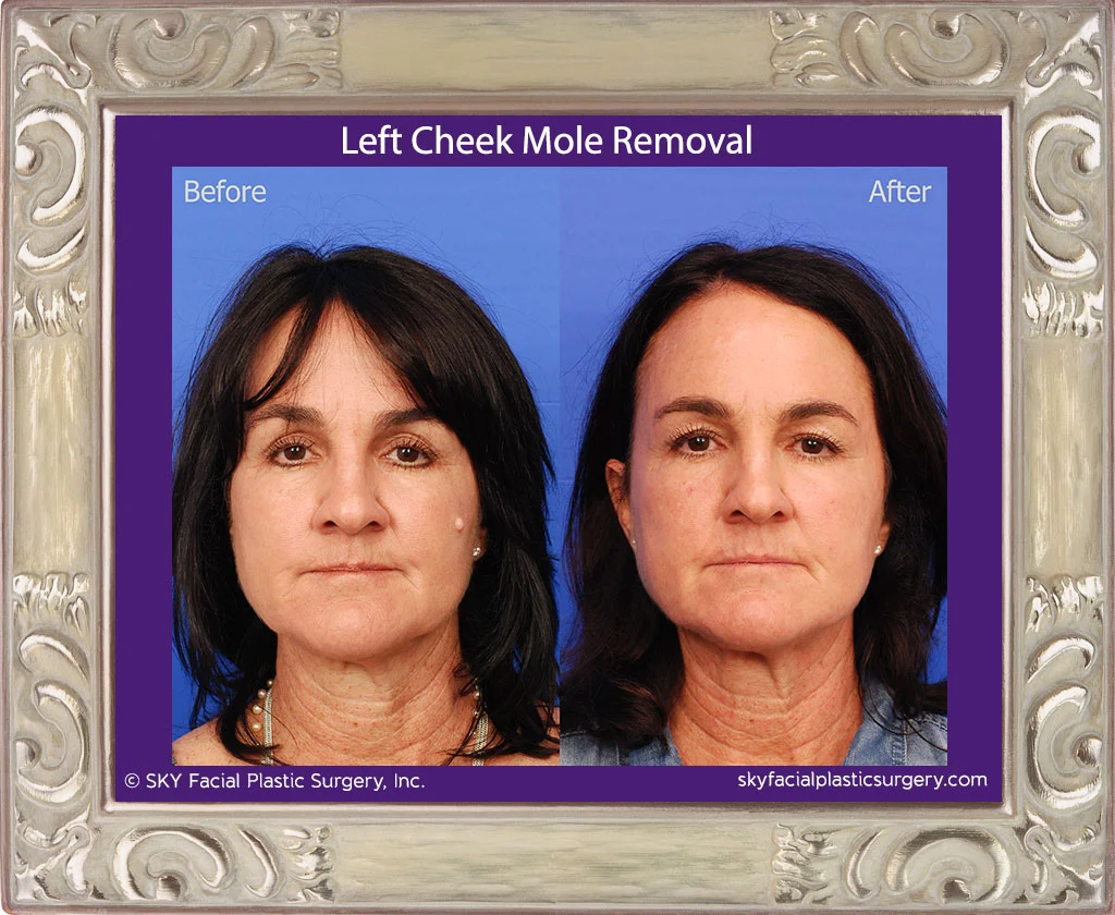 Mole Removal | San Diego — SKY Facial Plastic Surgery