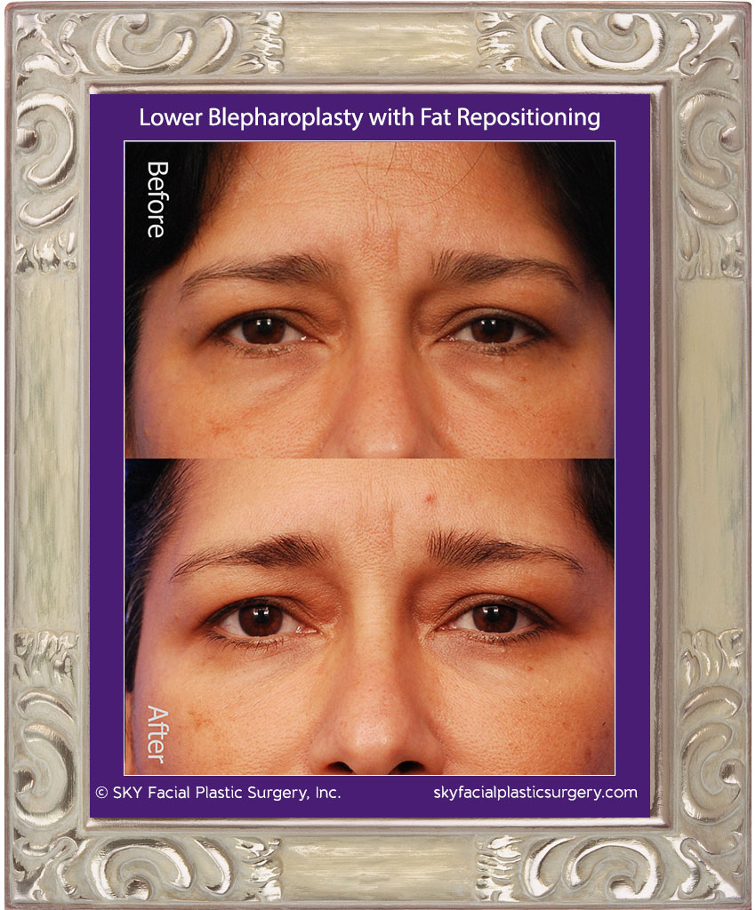 Transconjunctival lower blepharoplasty with fat repositioning - San Diego