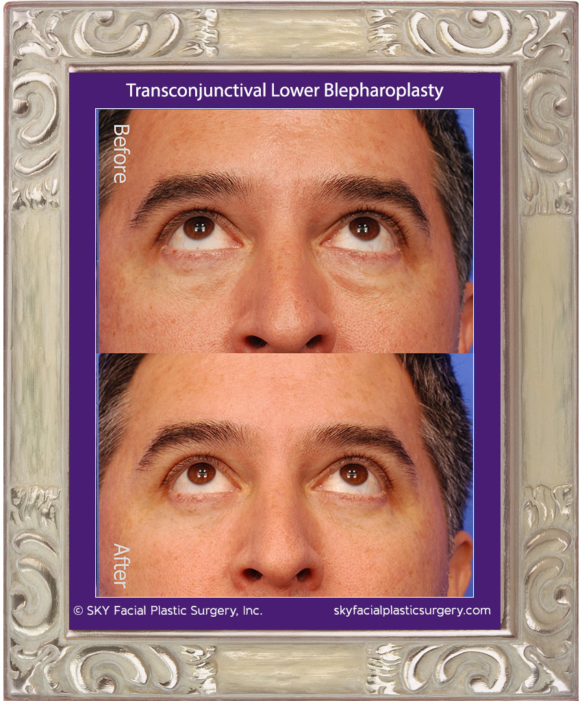 Transconjunctival Lower Blepharoplasty with Fat Repositioning