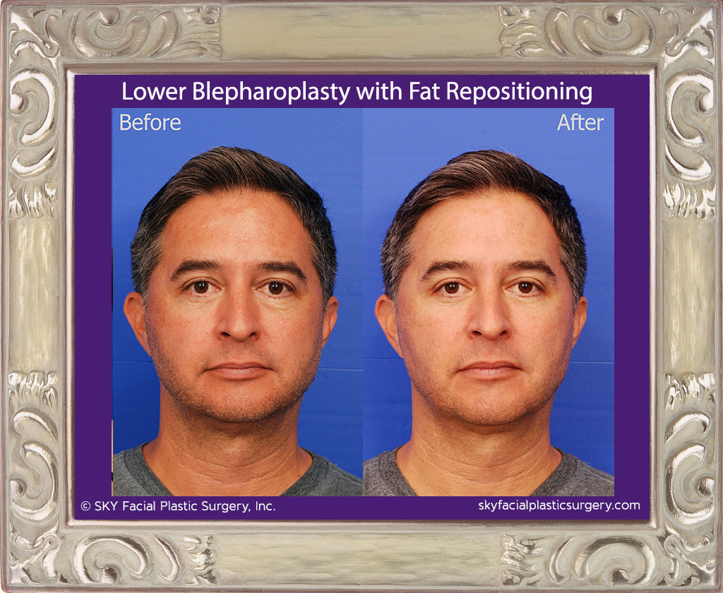 Transconjunctival Lower Blepharoplasty with Fat Repositioning