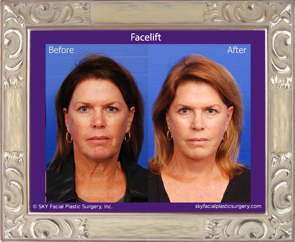 Facelift - San Diego