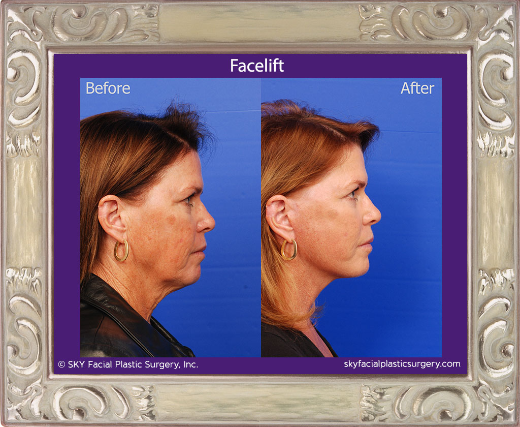 Facelift - San Diego
