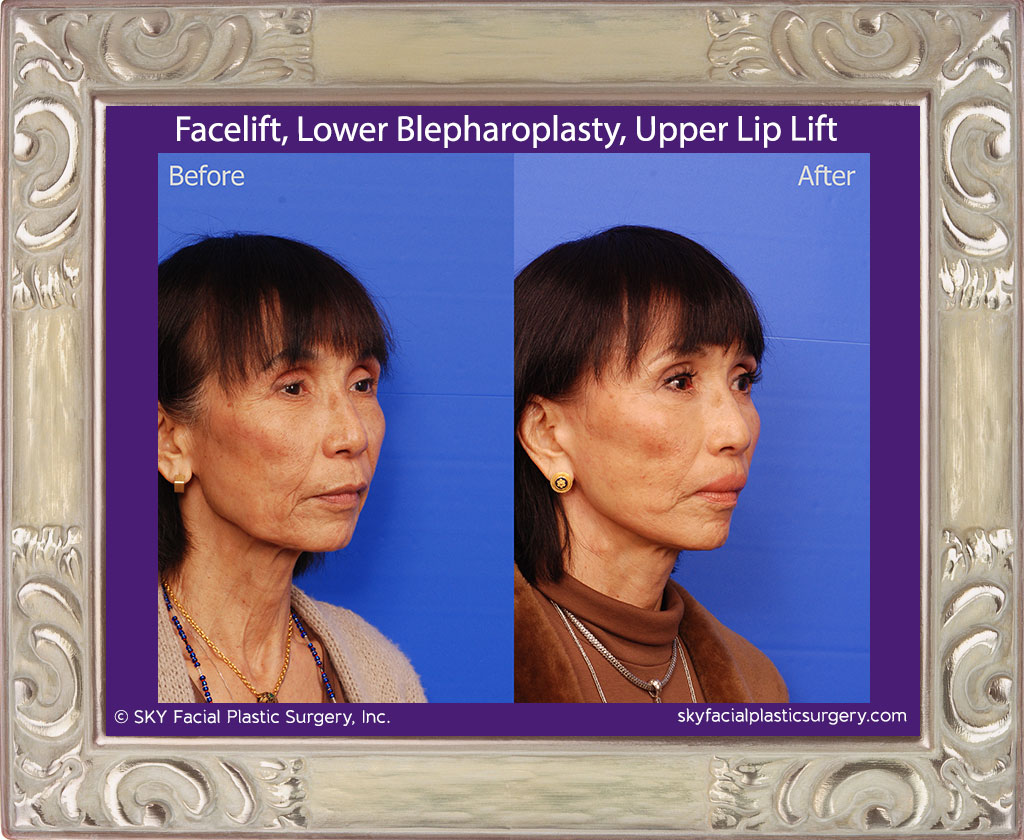 Facelift - San Diego