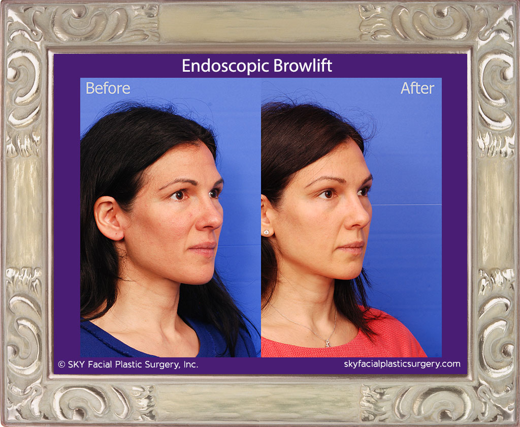 Endoscopic Brow Lift