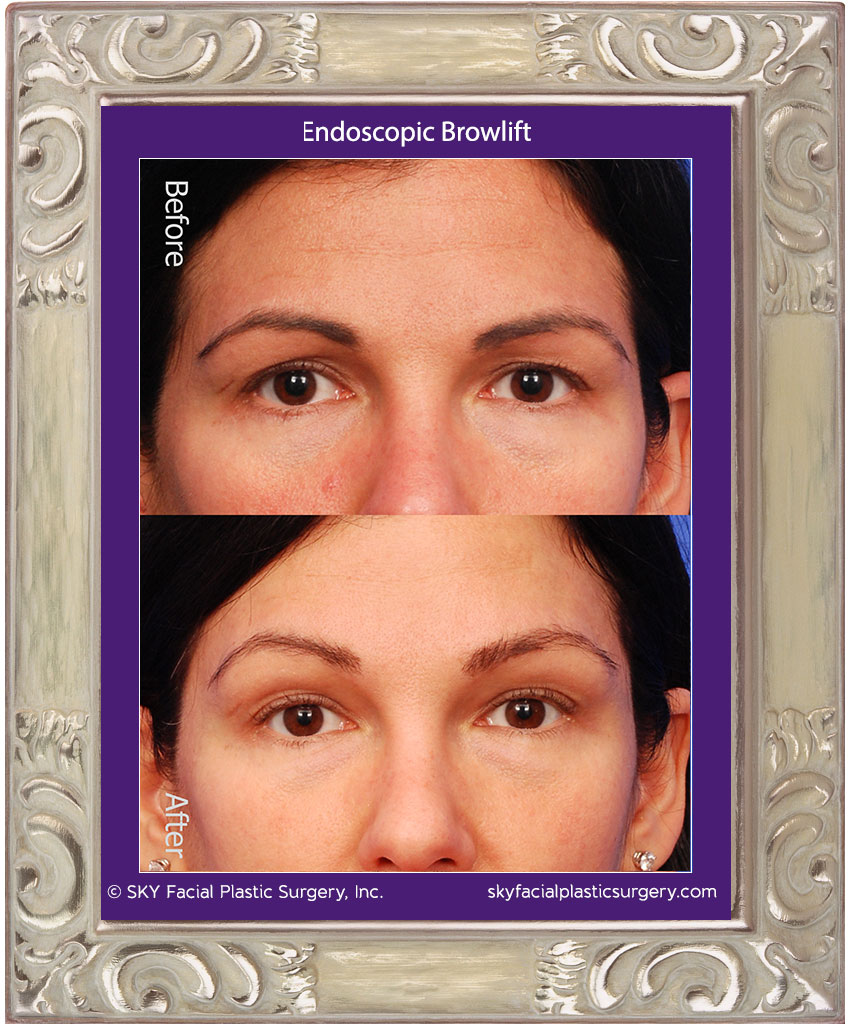 Endoscopic Brow Lift - San Diego