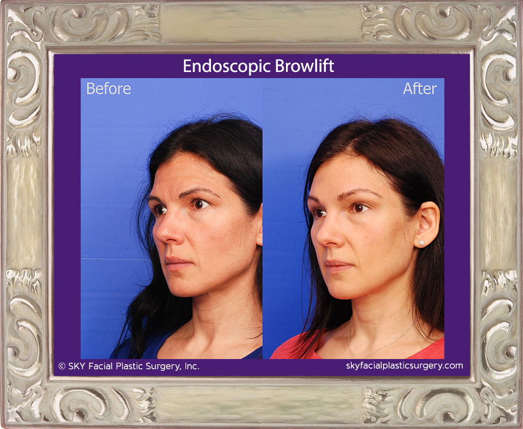 Endoscopic Brow Lift 