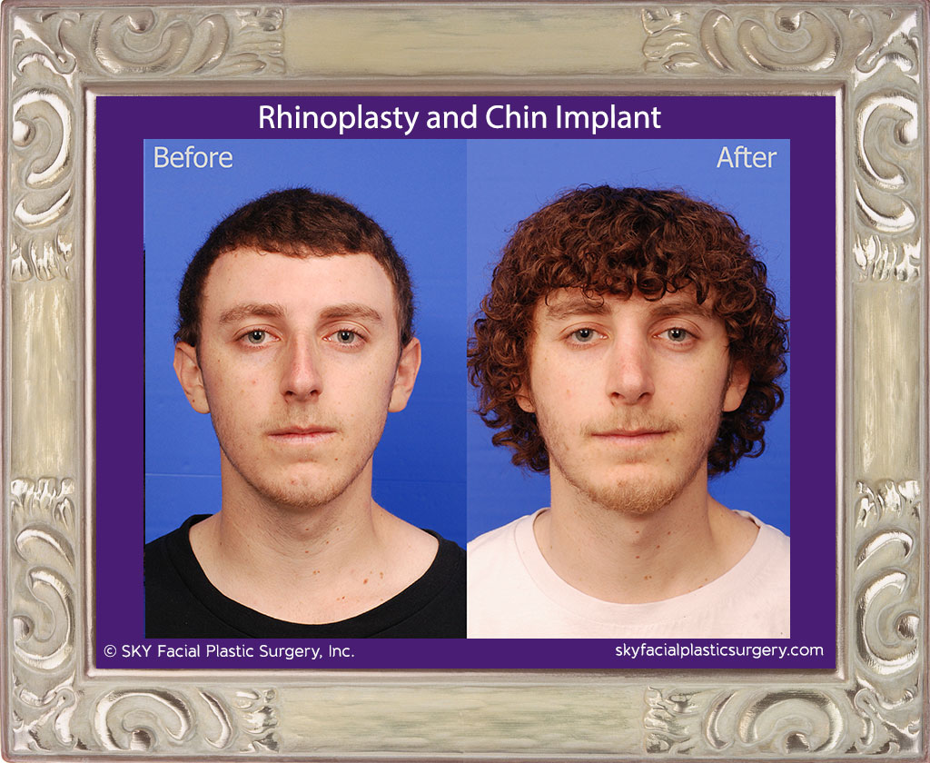 Chin Implant and Rhinoplasty - San Diego