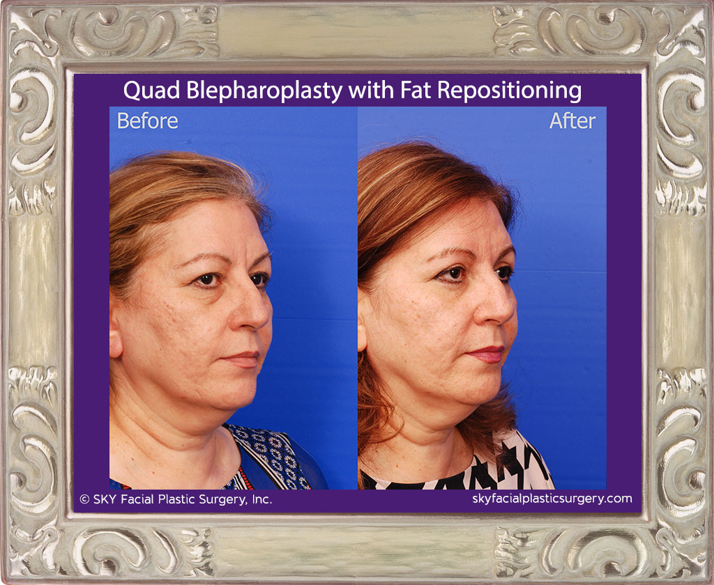 Upper and lower lid blepharoplasty with fat repositioning