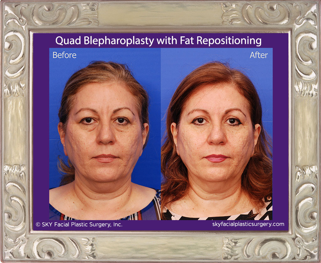 Upper and lower lid blepharoplasty with fat repositioning