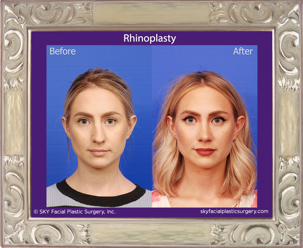 Austin Rhinoplasty Surgery