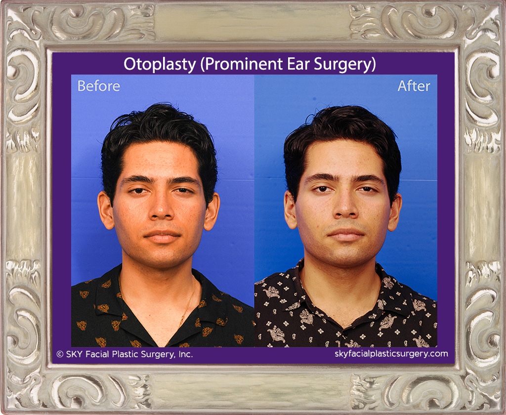 Otoplasty