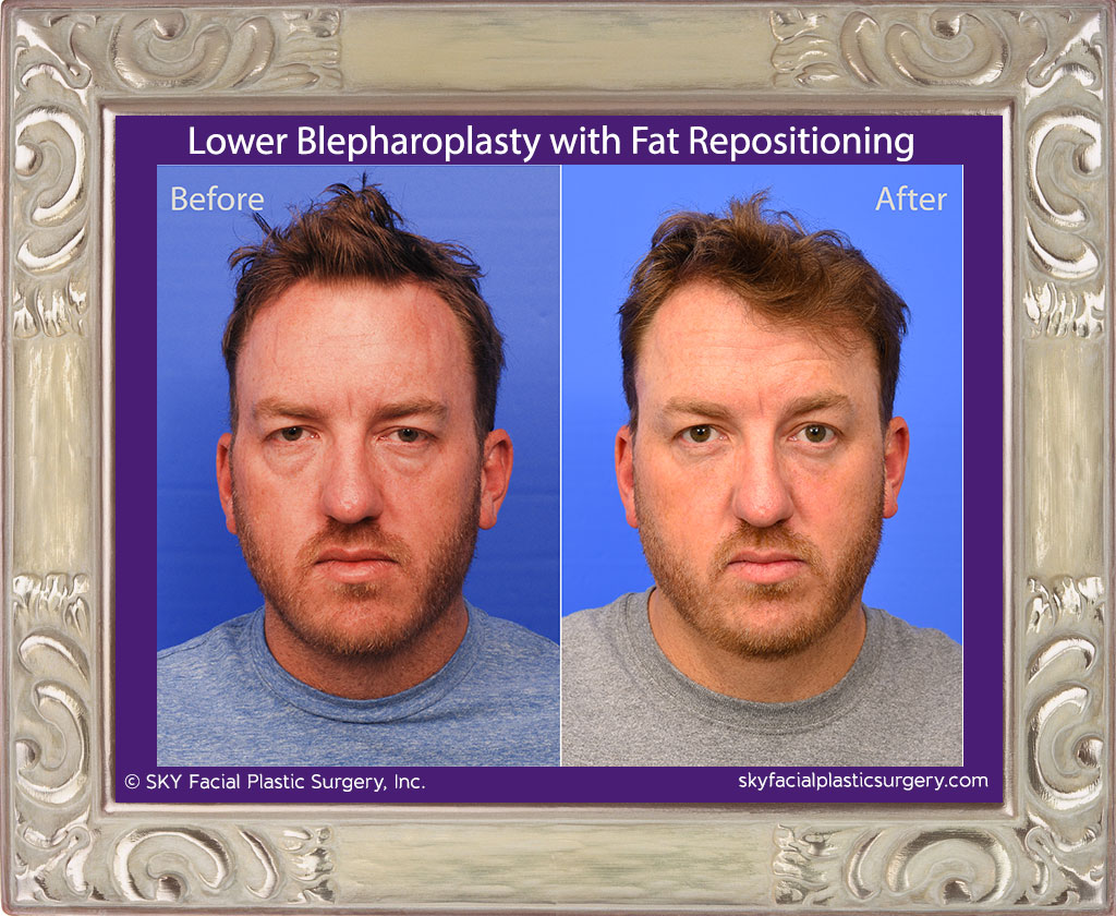 Lower Blepharoplasty with Fat Repositioning