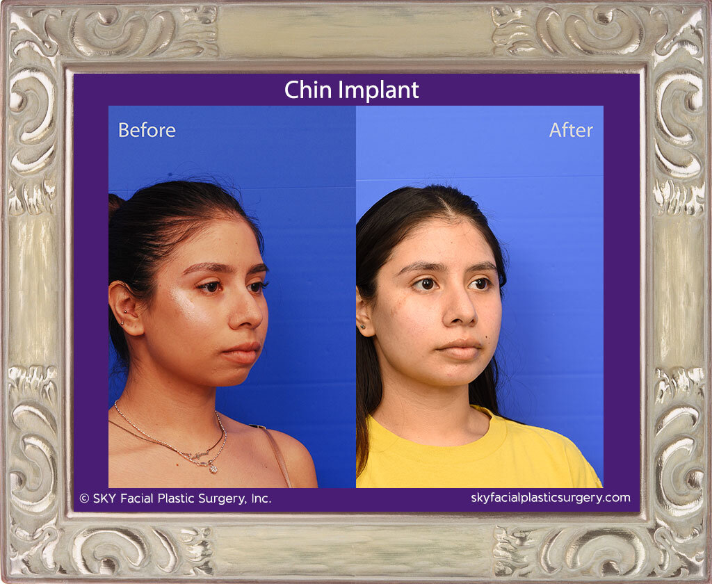Chin Implant - San Diego