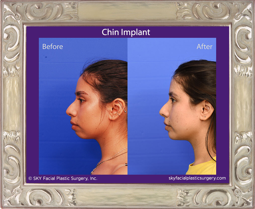 Chin Implant - San Diego