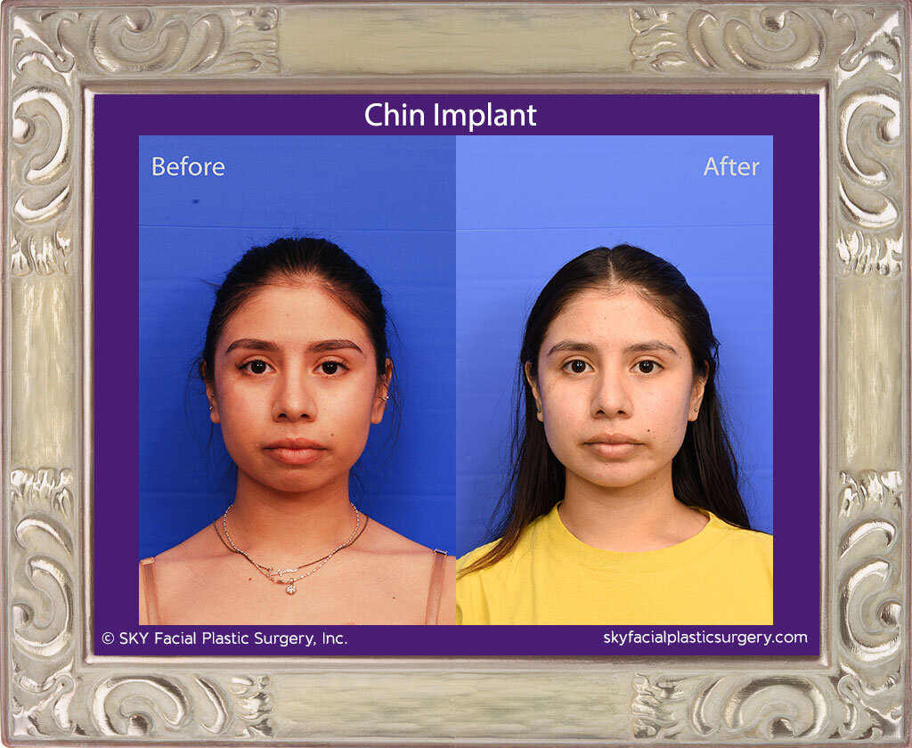 Chin Implant