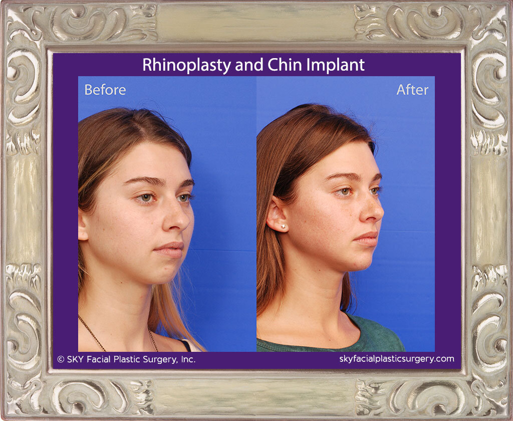 Rhinoplasty and Chin Implant
