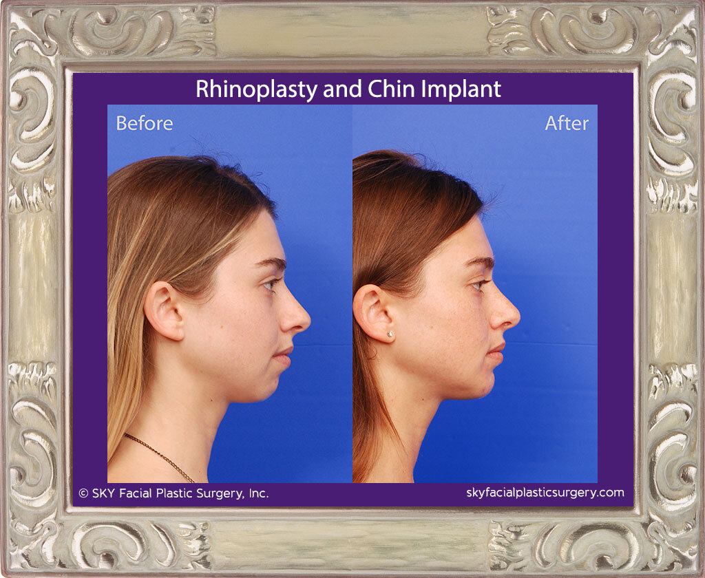 Rhinoplasty and Chin Implant