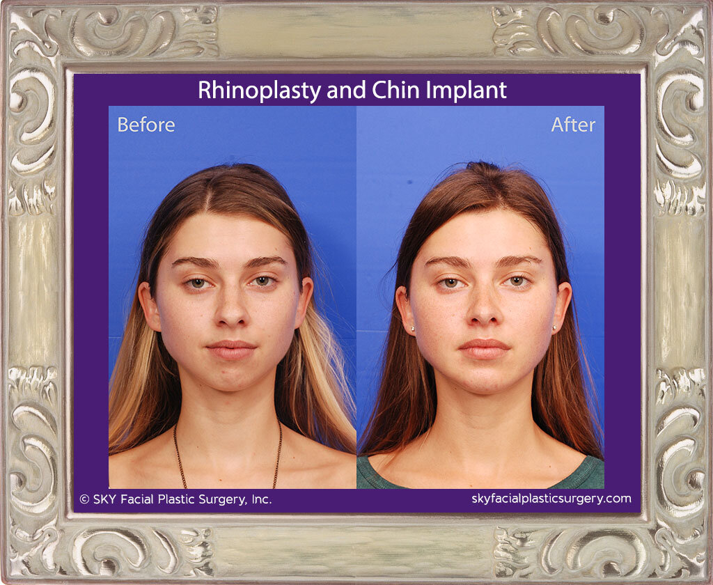Rhinoplasty and Chin Implant - San Diego