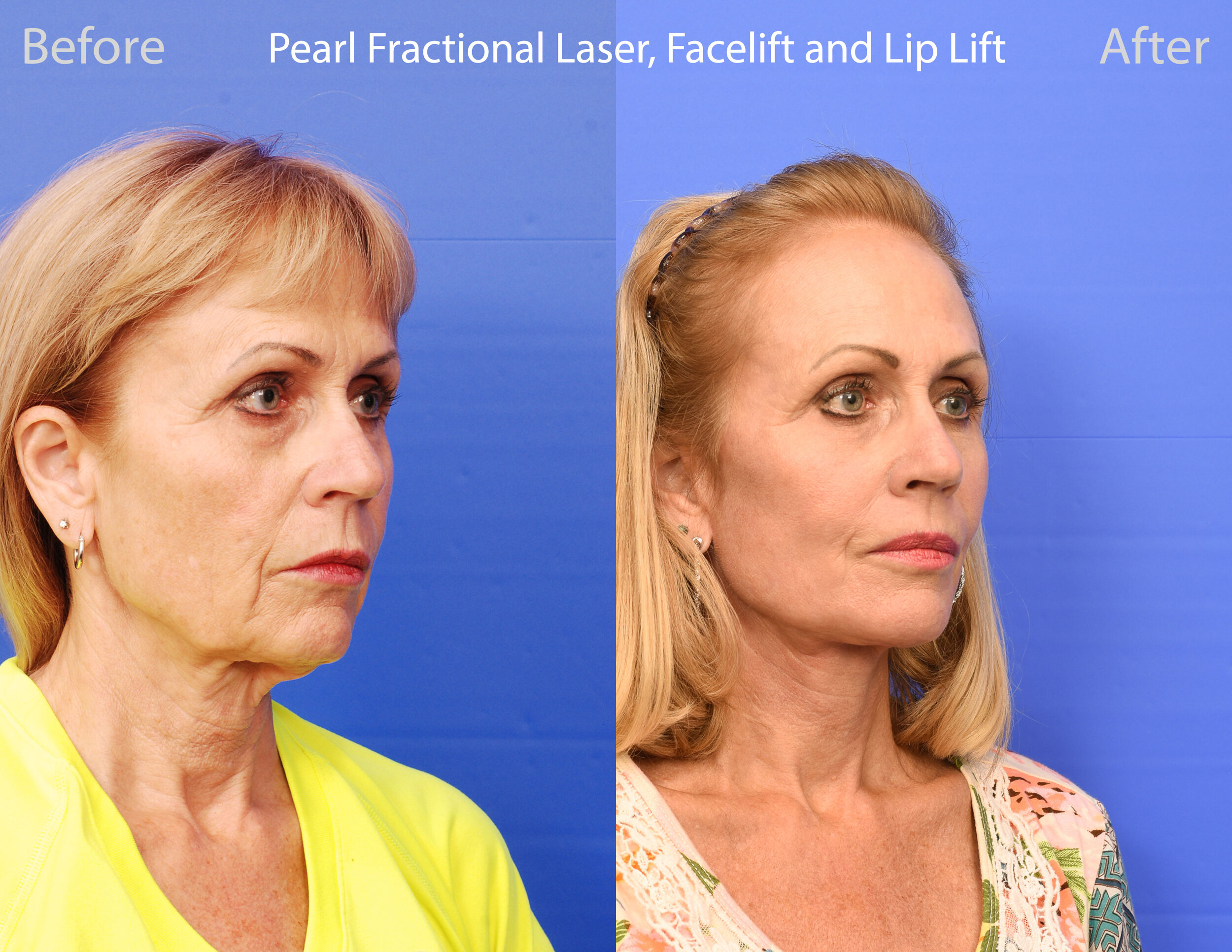 Pearl Fractional Laser, Facelift, Lip Lift