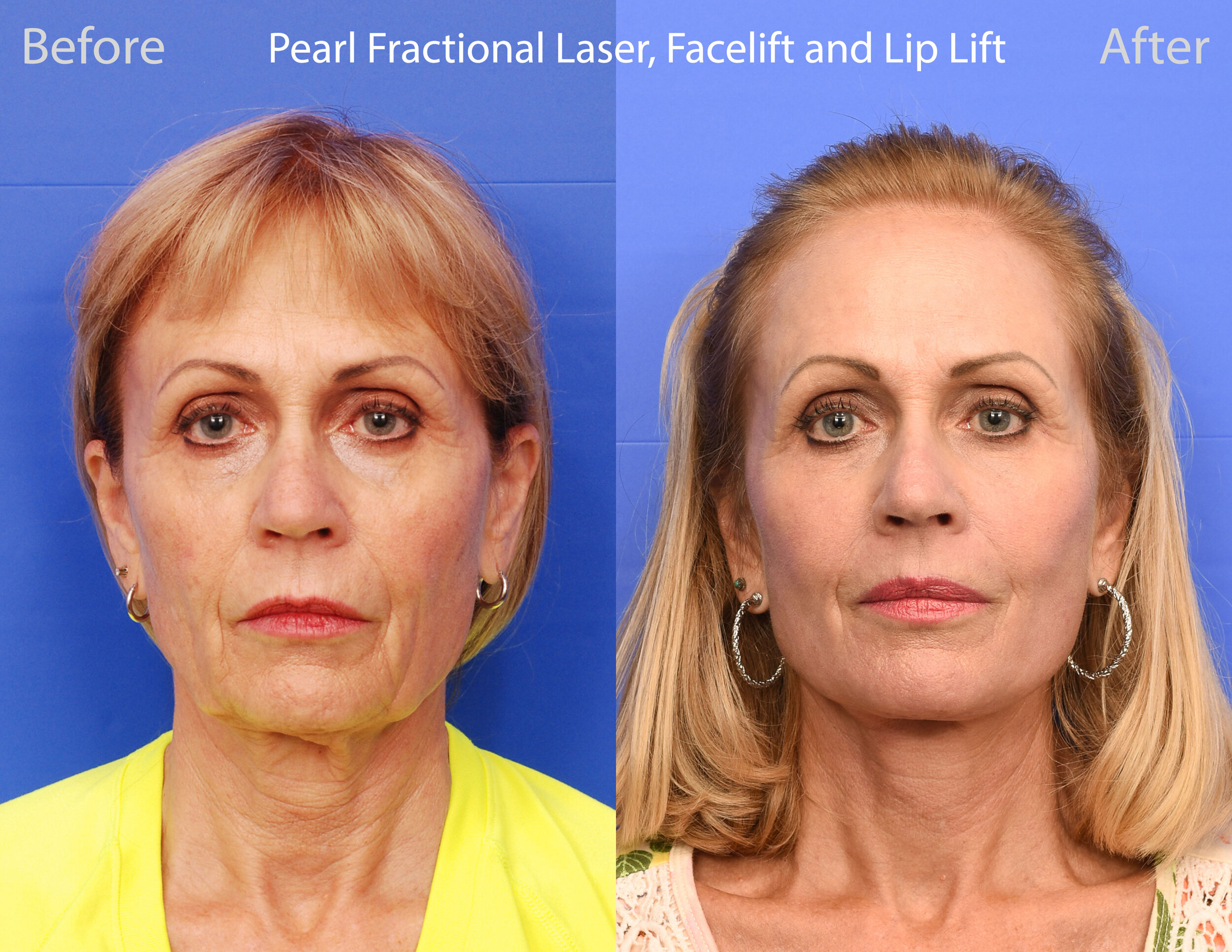 Pearl Fractional Laser, Facelift, Lip Lift