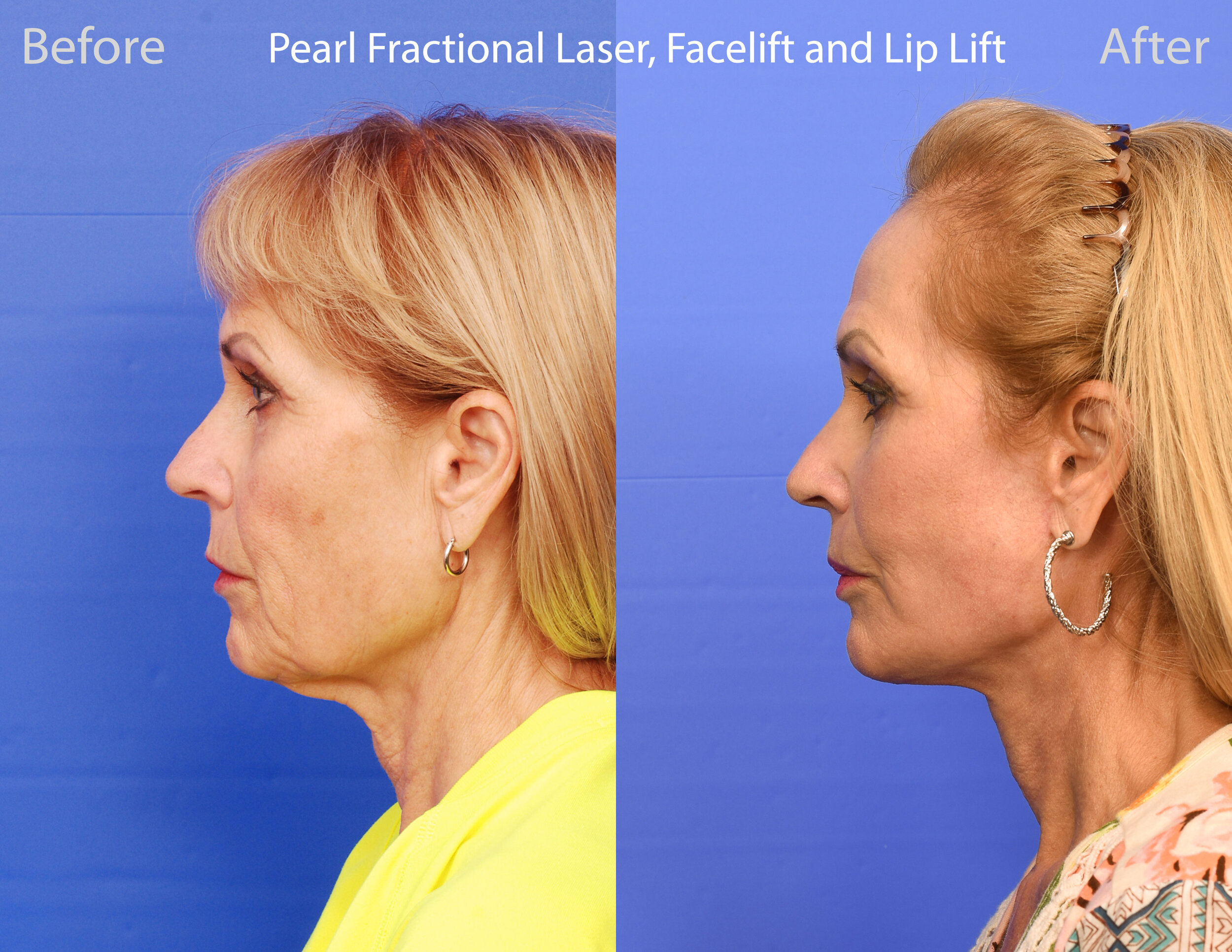 Pearl Fractional Laser, Facelift, Lip Lift