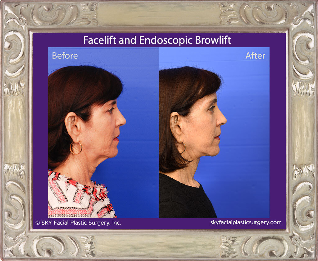 Facelift and Endoscopic Browlift