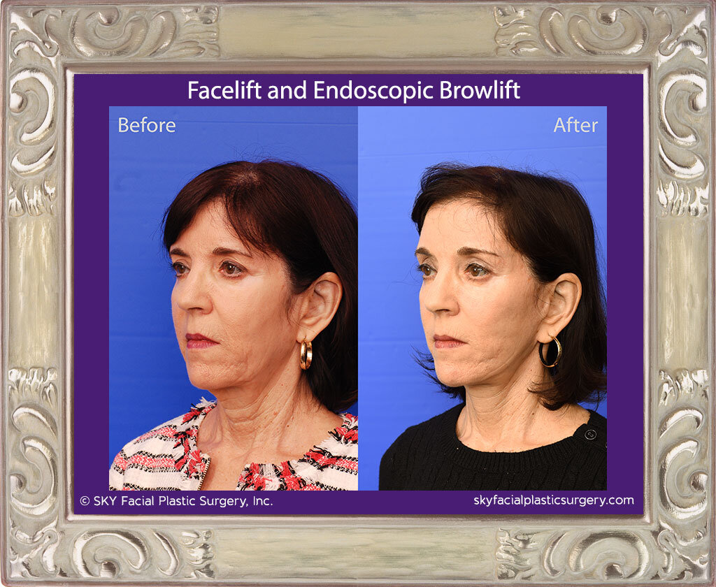 Facelift and Endoscopic Browlift