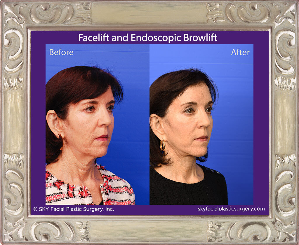 Facelift and Endoscopic Browlift