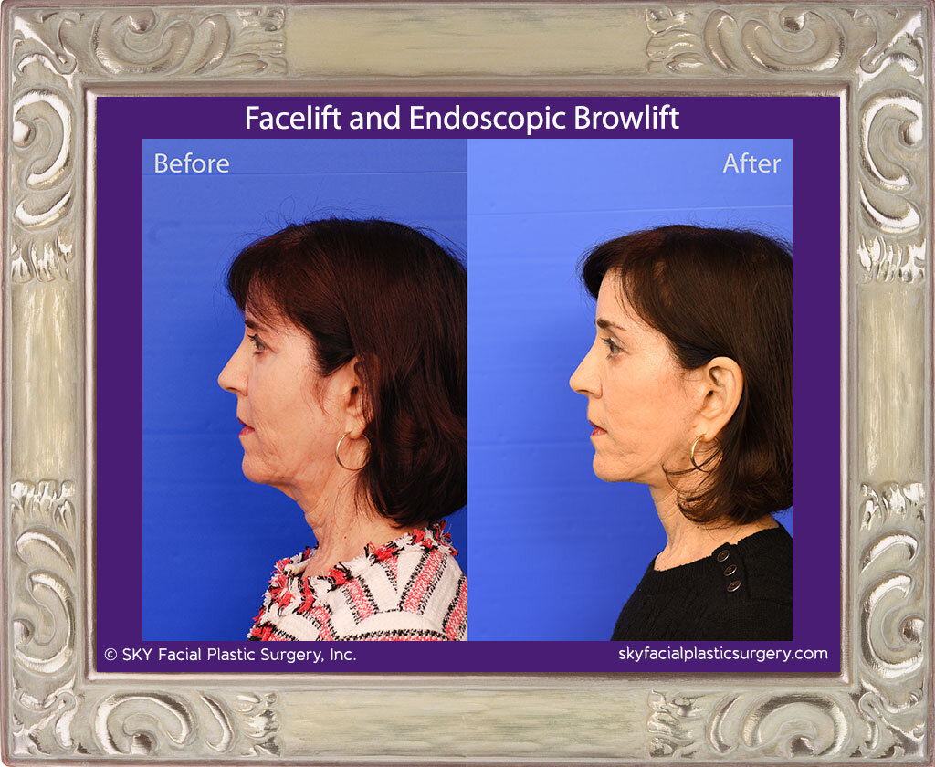 Facelift and Endoscopic Browlift