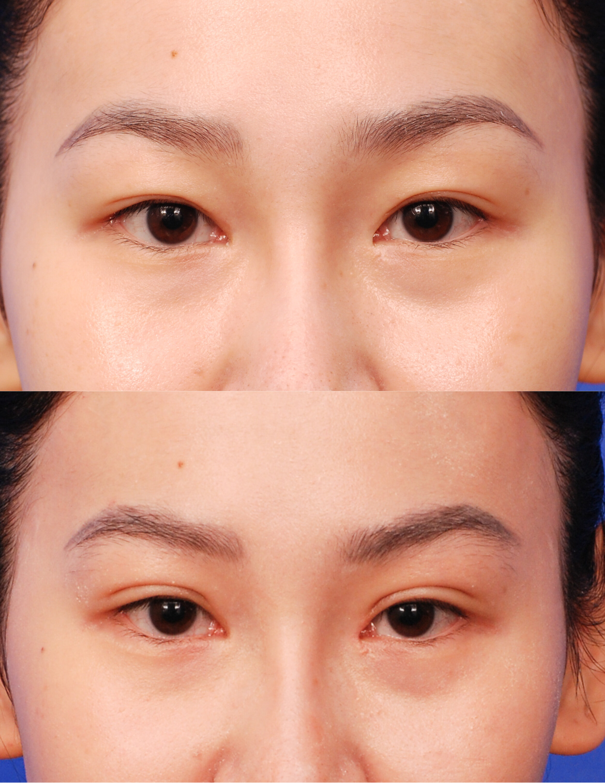 Asian blepharoplasty - San Diego