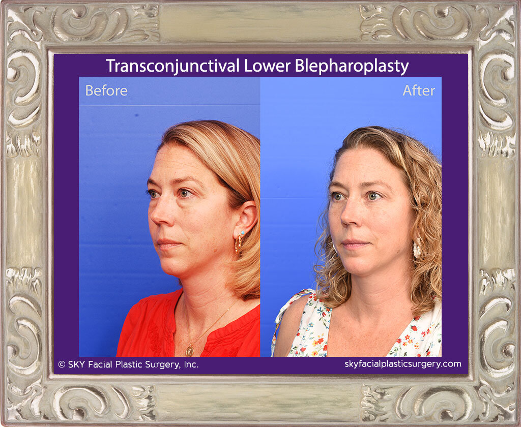 Transconjunctival Lower Blepharoplasty - San Diego