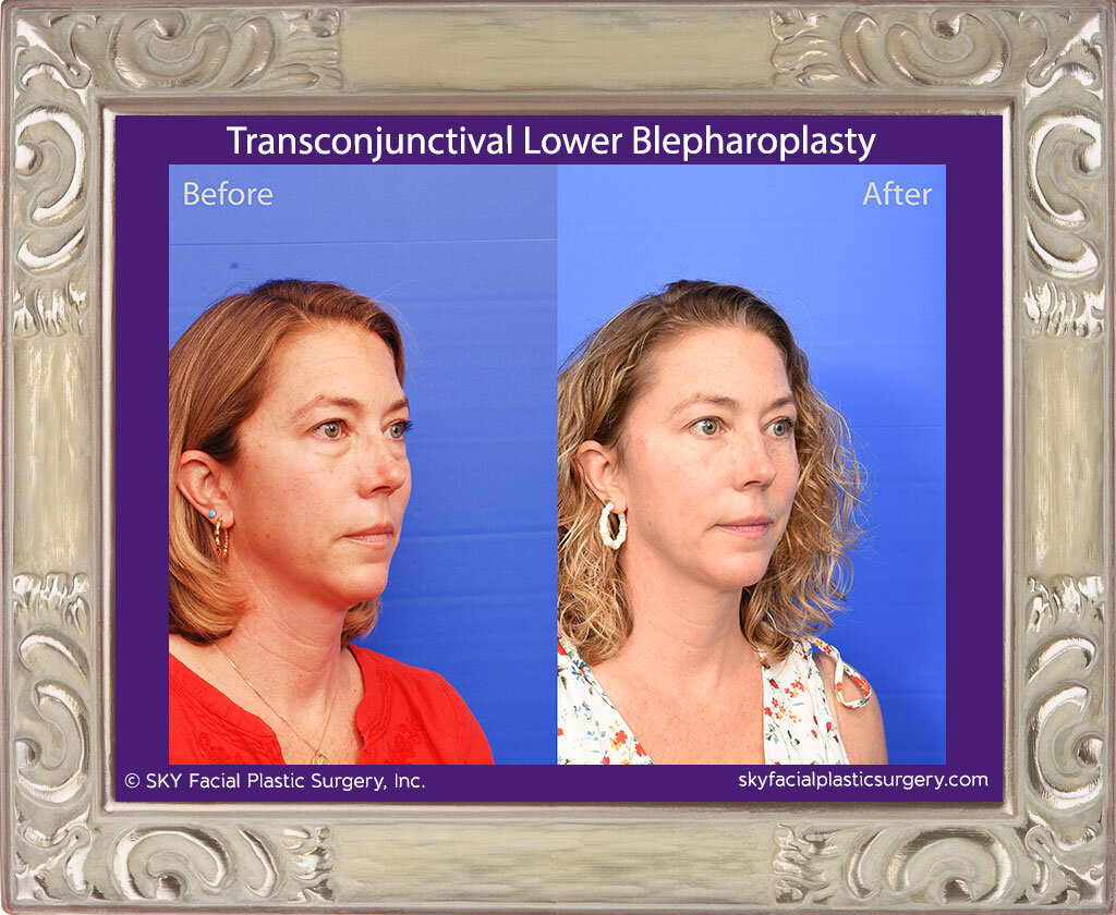 Transconjunctival Lower Blepharoplasty - San Diego