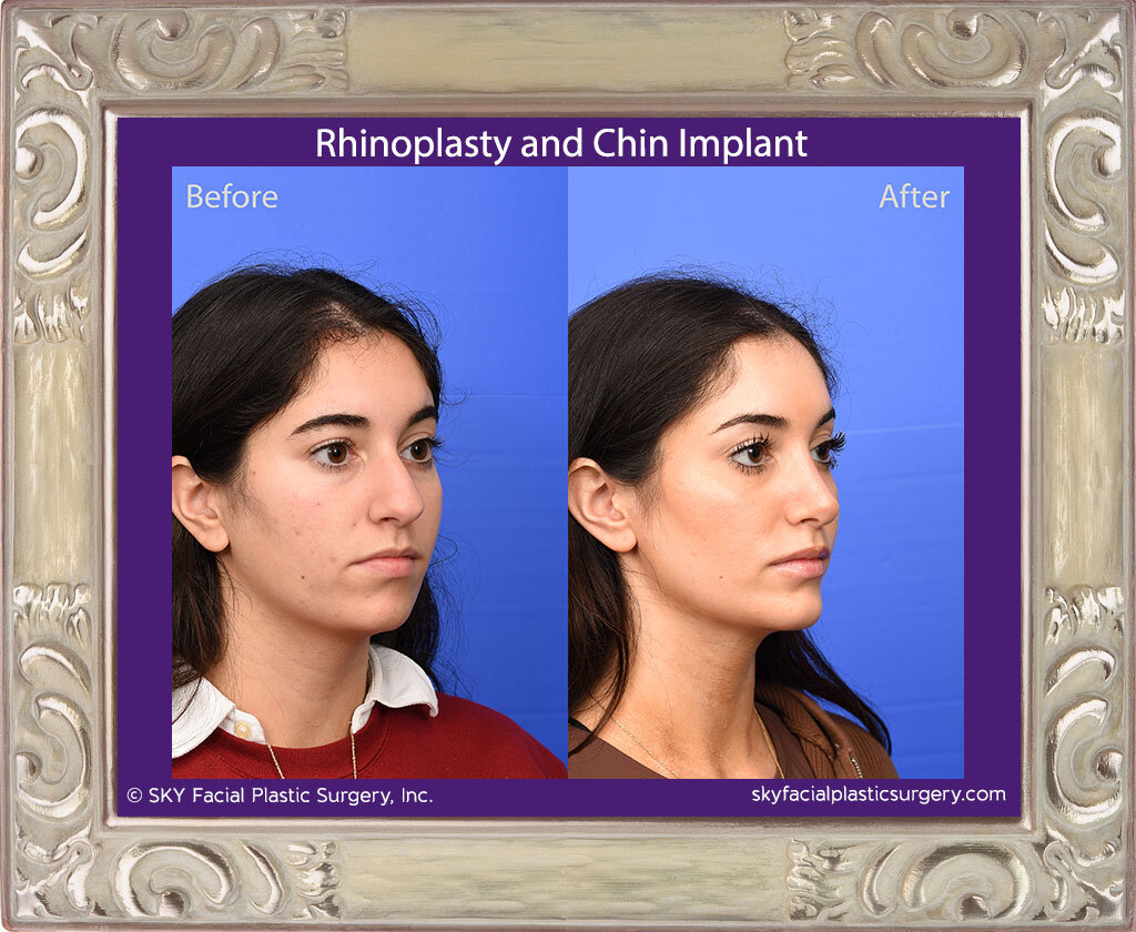 Rhinoplasty and chin implant - San Diego