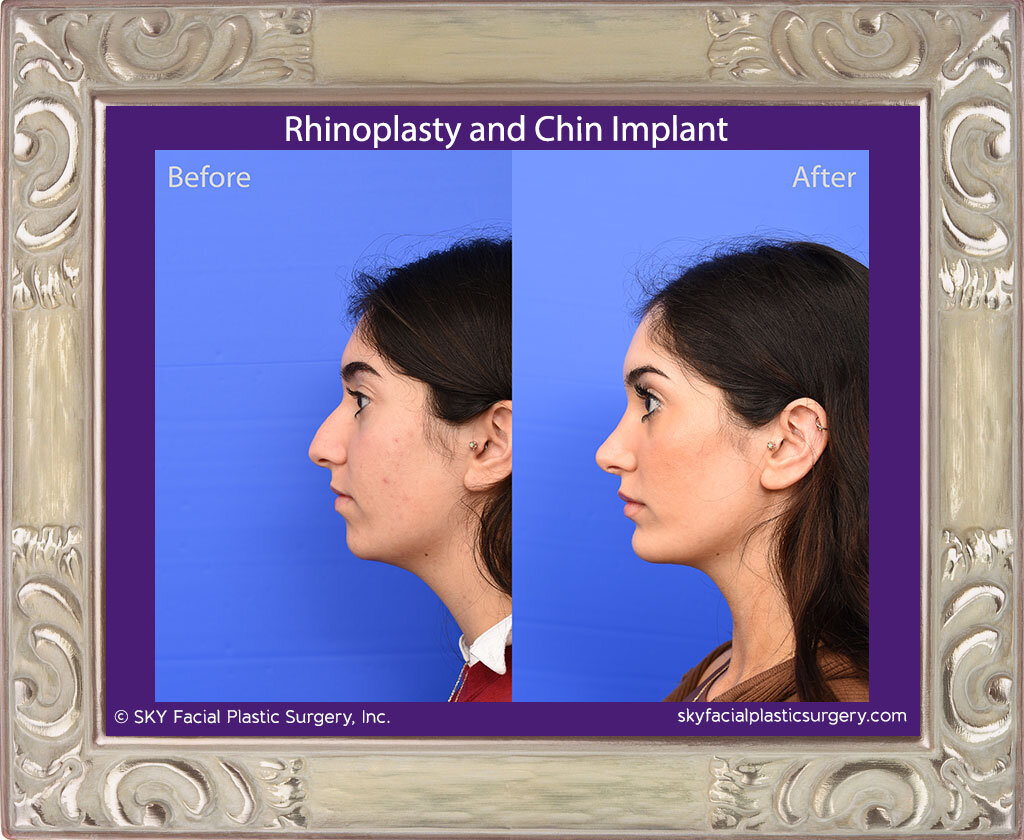 Rhinoplasty and chin implant - San Diego