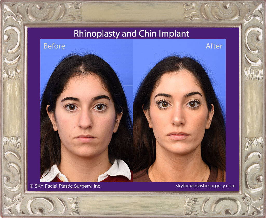 Rhinoplasty and chin implant - San Diego
