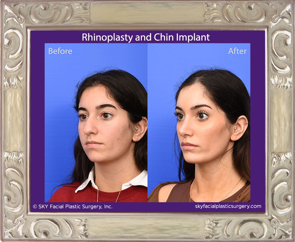 SKY-Facial-Plastic-Surgery-Rhinoplasty-66C.jpg