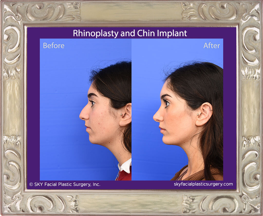 SKY-Facial-Plastic-Surgery-Rhinoplasty-66B.jpg