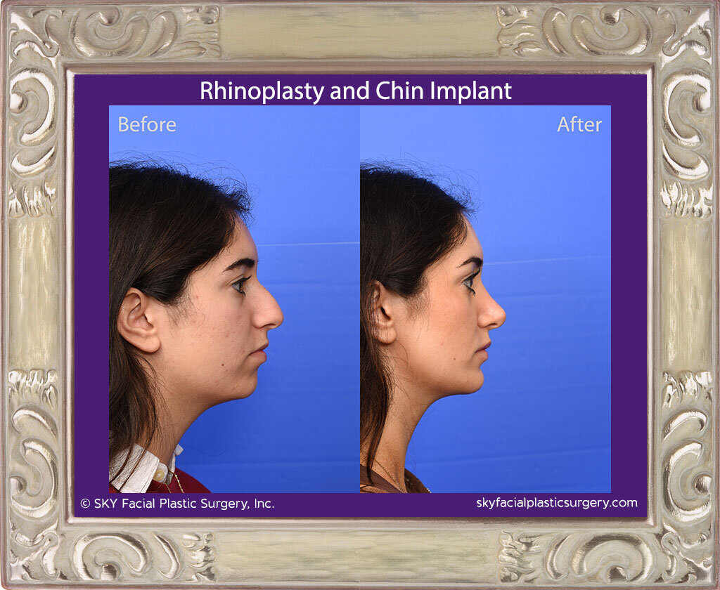 SKY-Facial-Plastic-Surgery-Rhinoplasty-66E.jpg