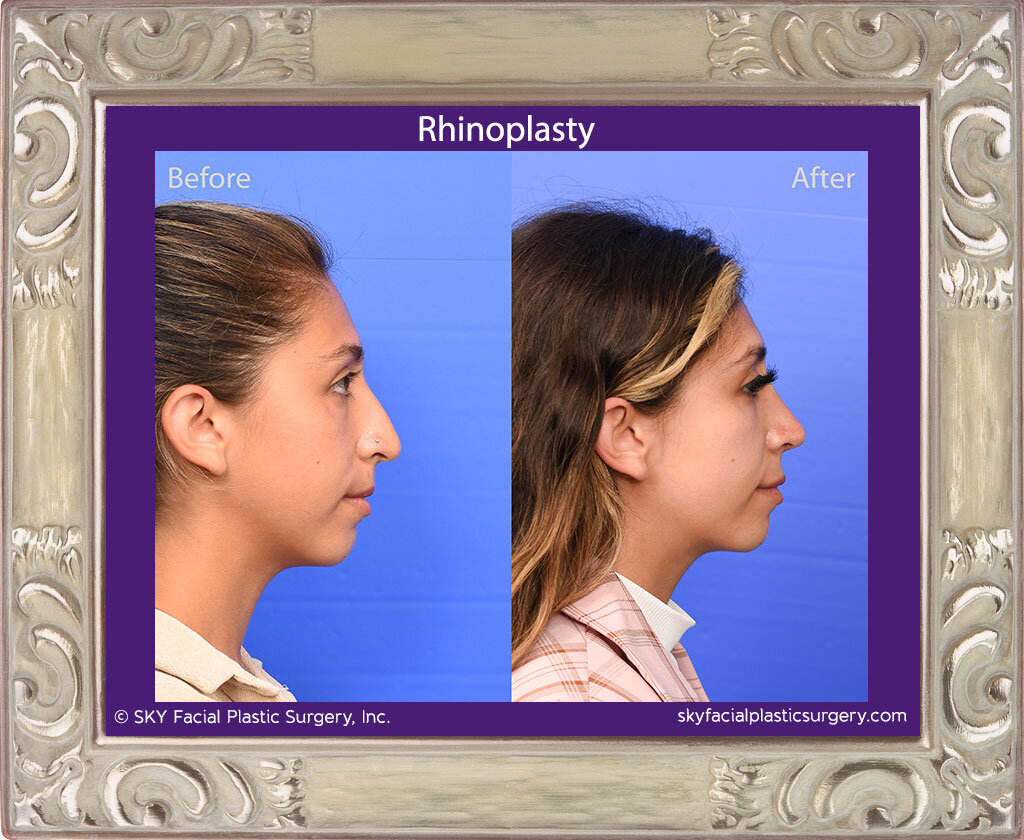 SKY-Facial-Plastic-Surgery-Rhinoplasty-67E.jpg