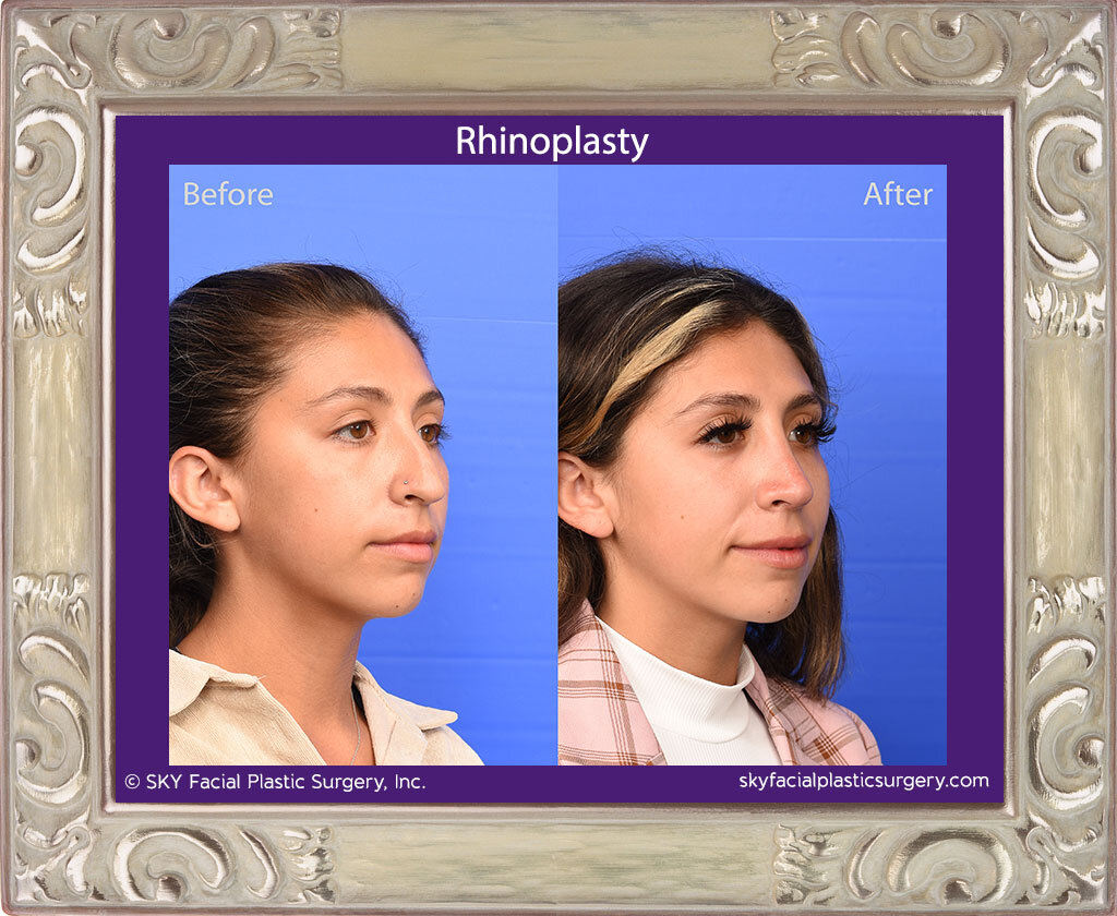 SKY-Facial-Plastic-Surgery-Rhinoplasty-67D.jpg