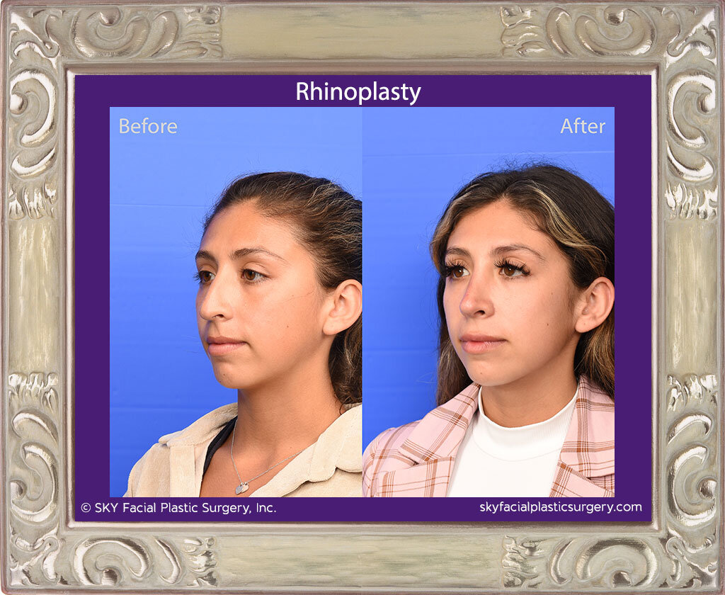 SKY-Facial-Plastic-Surgery-Rhinoplasty-67C.jpg