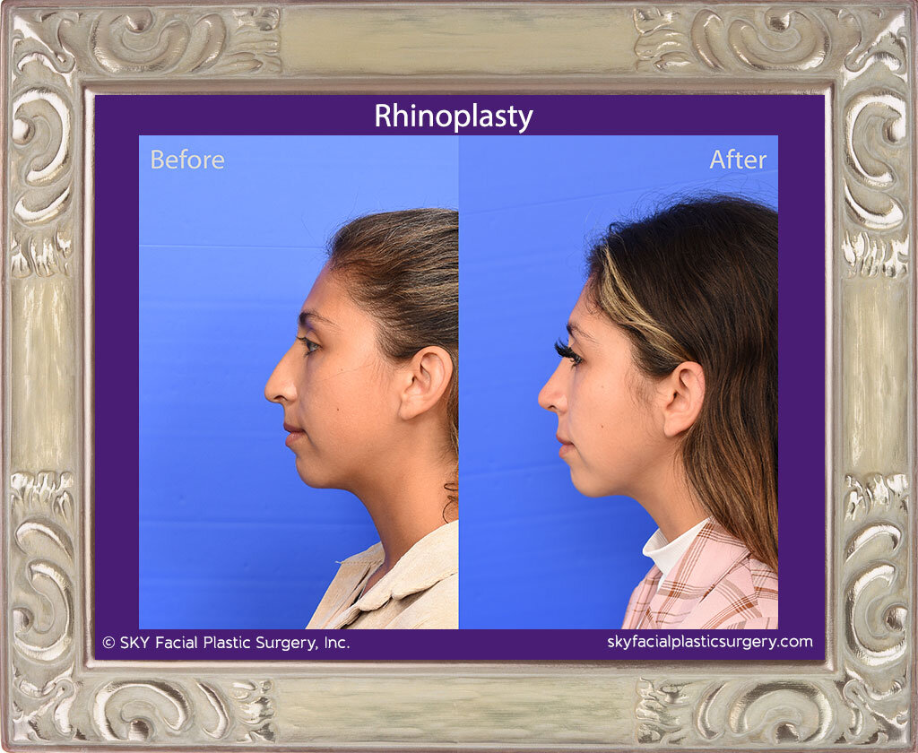 SKY-Facial-Plastic-Surgery-Rhinoplasty-67B.jpg